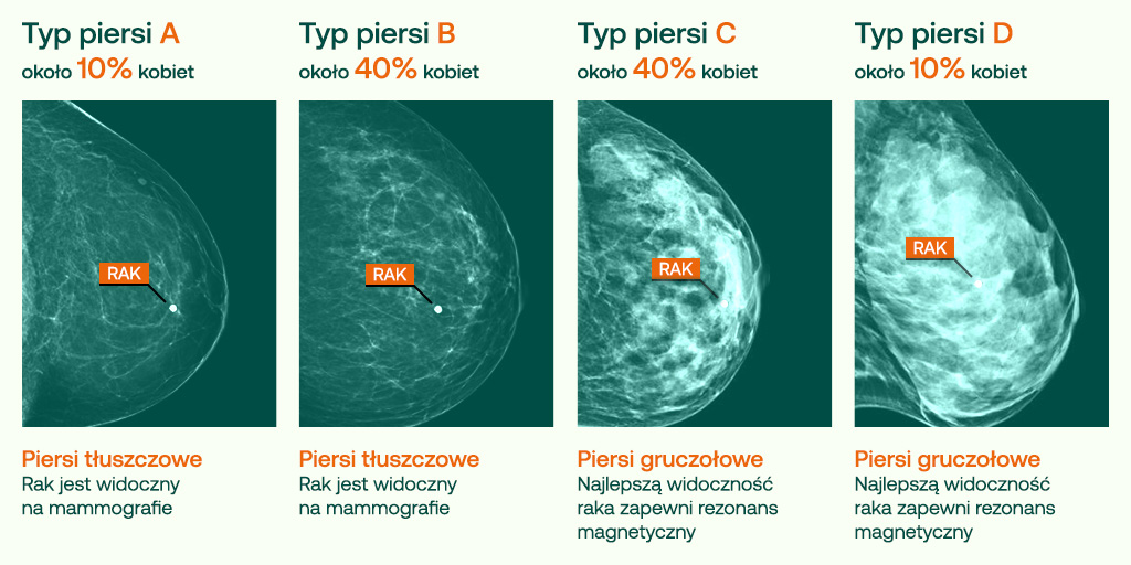 Piersi gruczołowe grafika