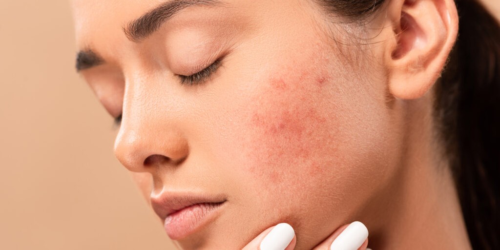 Gronkowiec na twarzy