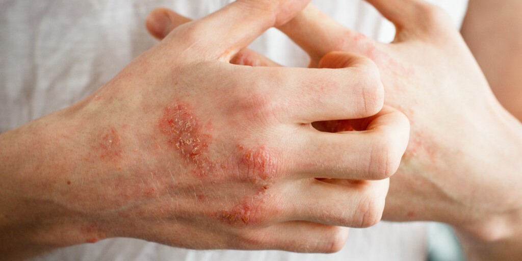 Zapalenie skórno-mięśniowe