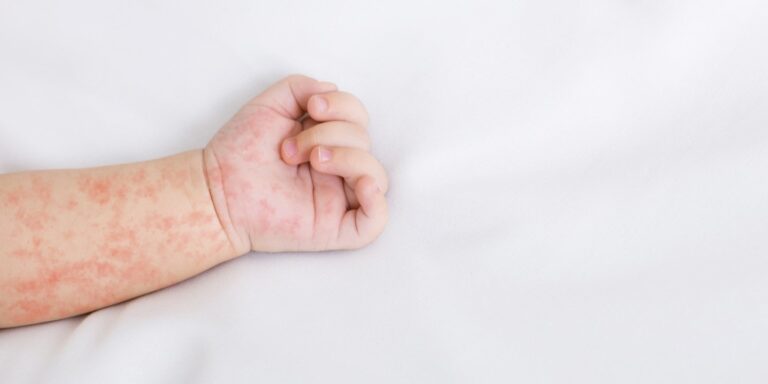 Sepsa Reki Sepsa u dzieci – jak ją zdiagnozować? | Diag.pl