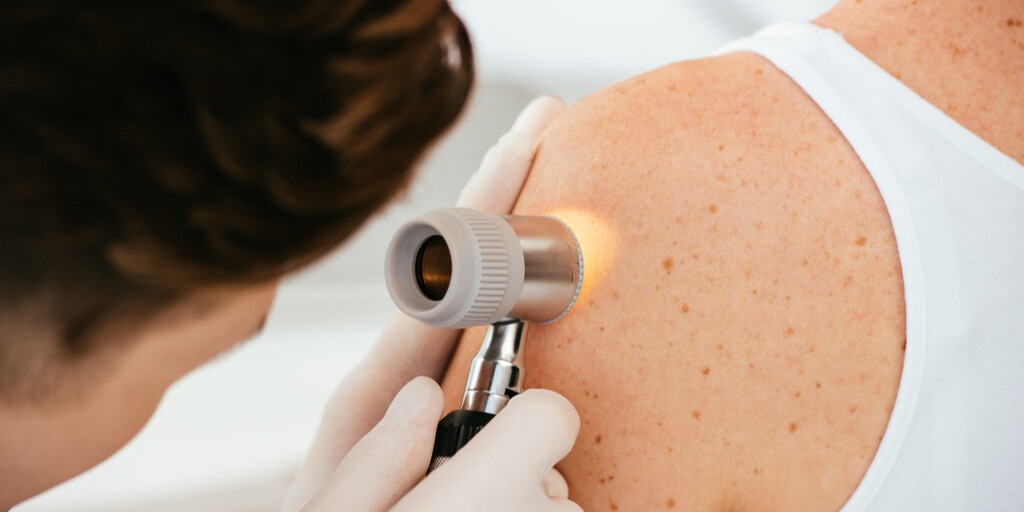 Brodawka łojotokowa a czerniak